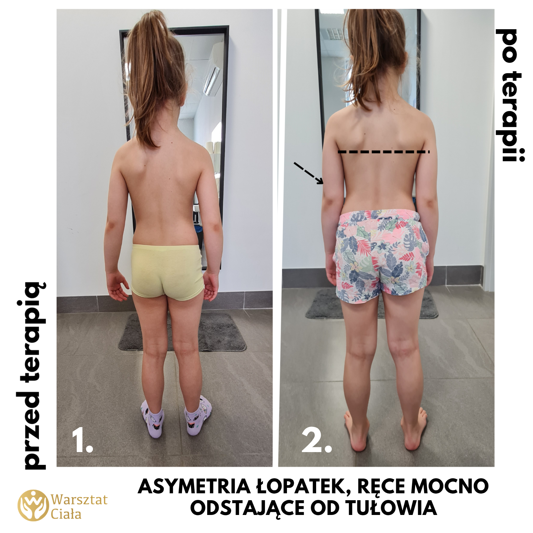 fizjoterapia dzieci przed i po 4